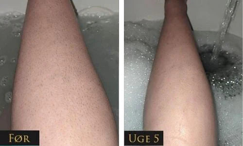 Sistema di rimozione dei peli IPL LumaNova per uso domestico per una pelle liscia