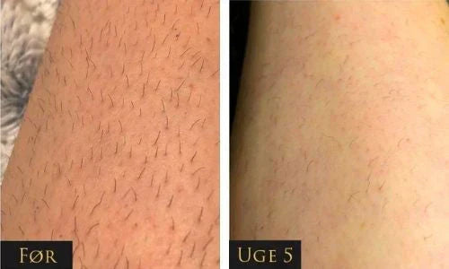 Sistema di rimozione dei peli IPL LumaNova per uso domestico per una pelle liscia