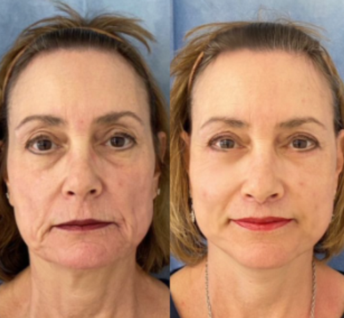 מסכת קולגן מנאופייבר ללחות והפחתת קמטים