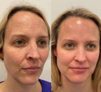 מסכת קולגן מנאופייבר ללחות והפחתת קמטים