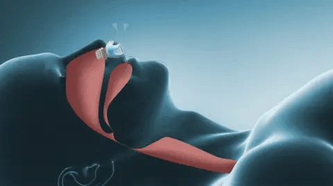 AeroRest Alternativa Portátil CPAP Para Apnea del Sueño y Ronquidos, Ligero Silencioso Sin Máscara Recargable por USB