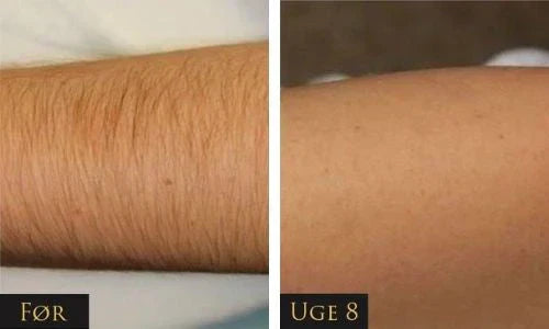 Sistema di rimozione dei peli IPL LumaNova per uso domestico per una pelle liscia